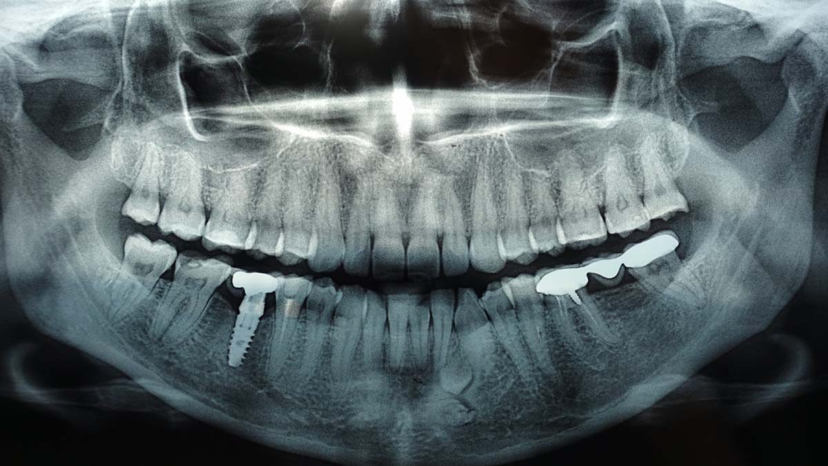 Comprehensive Dental Xrays in Pune Katraj, Kondhwa, & Rasta Peth
