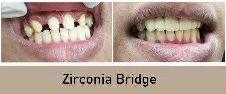 zirconia bridge