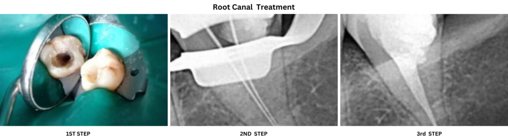 Root Canal Treatment Steps - Aple Dentist
