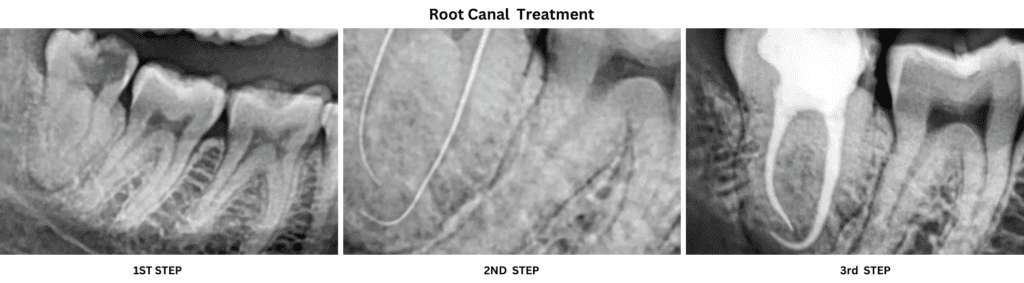 Root Canal Treatment Steps - Aple Dentist