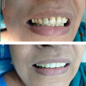 Dental Restoration or Filling in Pune