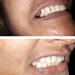 Dental Restoration or Filling in Pune Aple Dentist