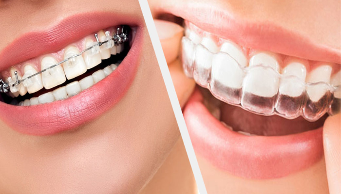 What are "clear braces" or "clear aligners," and where can we get the finest care for them in Pune?