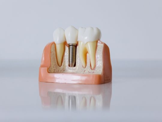 Dental Implant in Pune - Aple Dentist