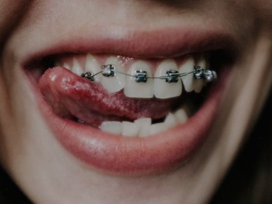 Traditional Metal Braces - Aple Dentist