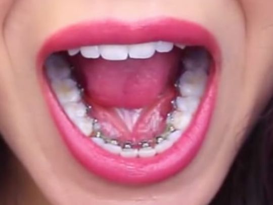 Lingual braces(Behind the teeth) - Aple Denist