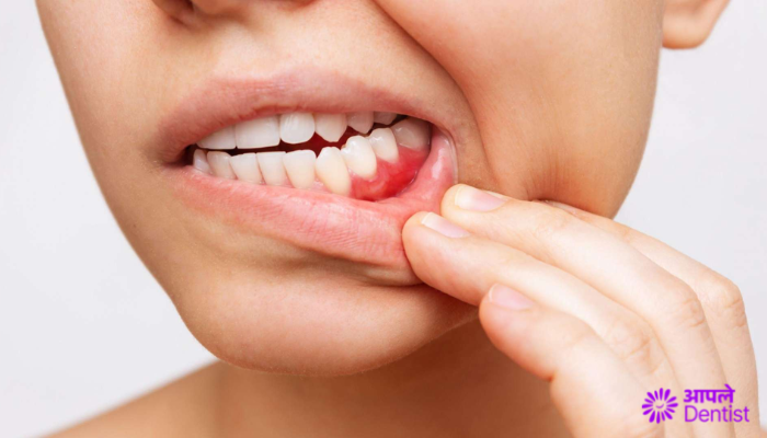 What Are Bleeding Gums & Why Should You Consult Dentist blog by Aple Dentist