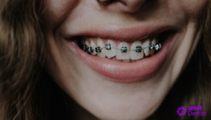 5 Tips For Caring And Maintaining Braces by Aple Dentist