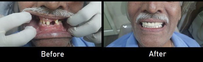 zirconia bridge2 zirconia bridge2